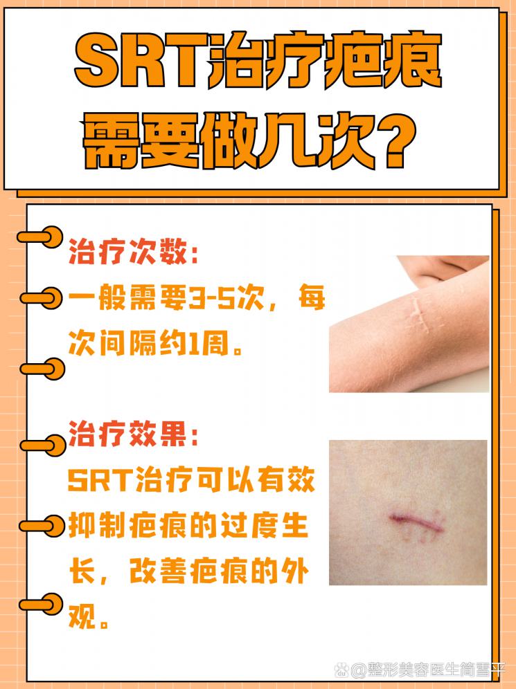 揭秘SRT疤痕治疗：次数与效果全解析