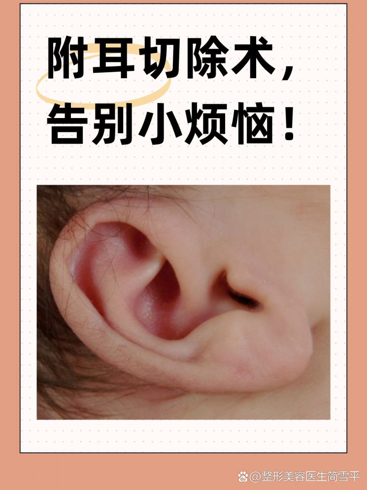 附耳切除术，告别小烦恼！
