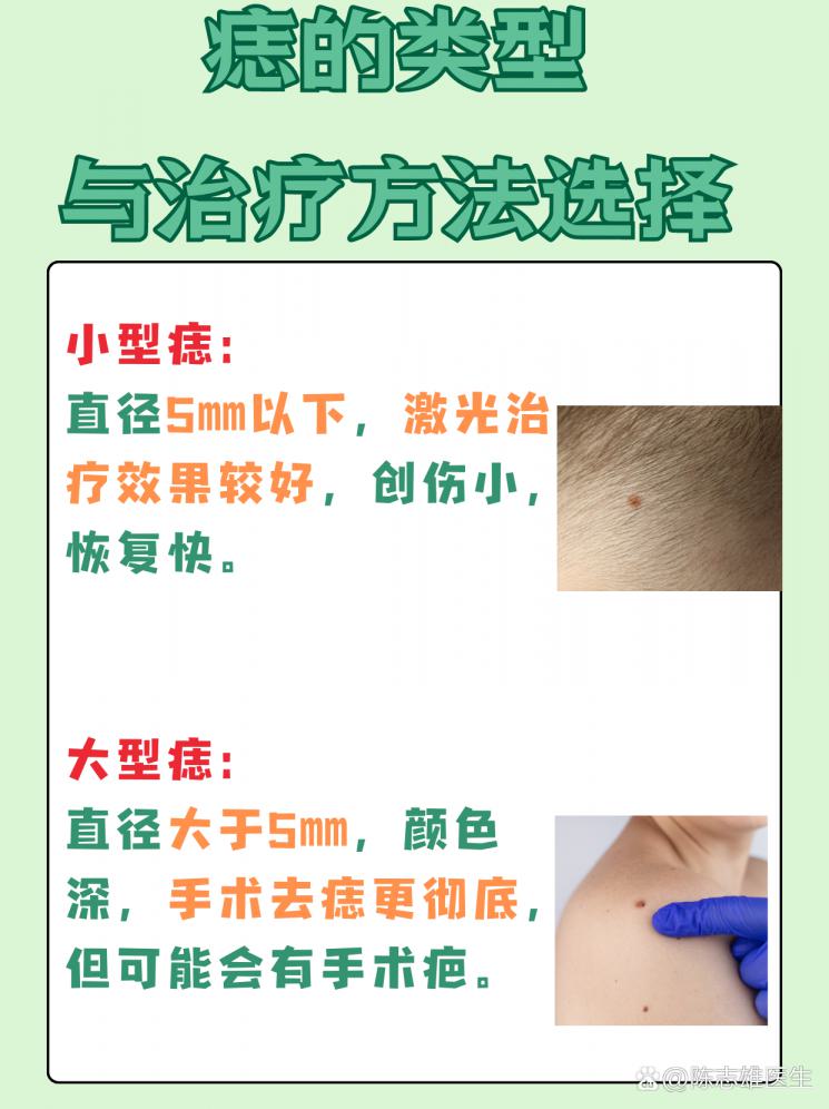 痣治疗：手术VS激光，哪个更胜一筹？