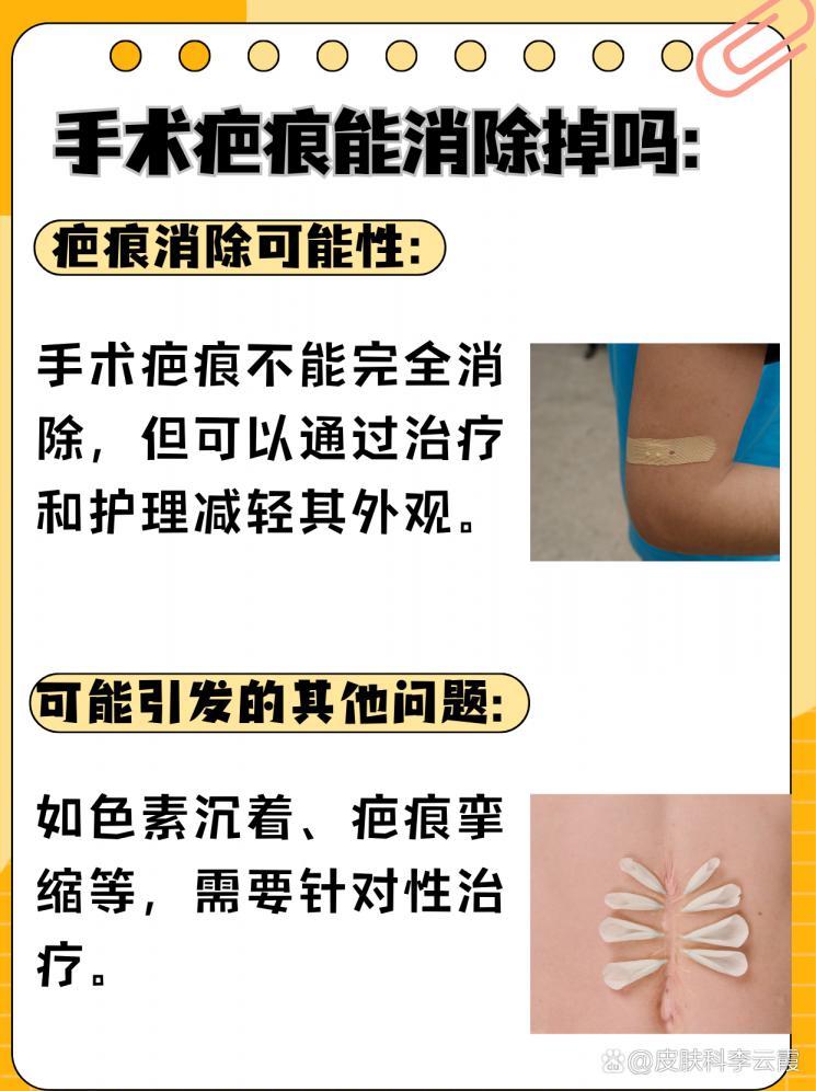 手术疤痕消除：可能与方法