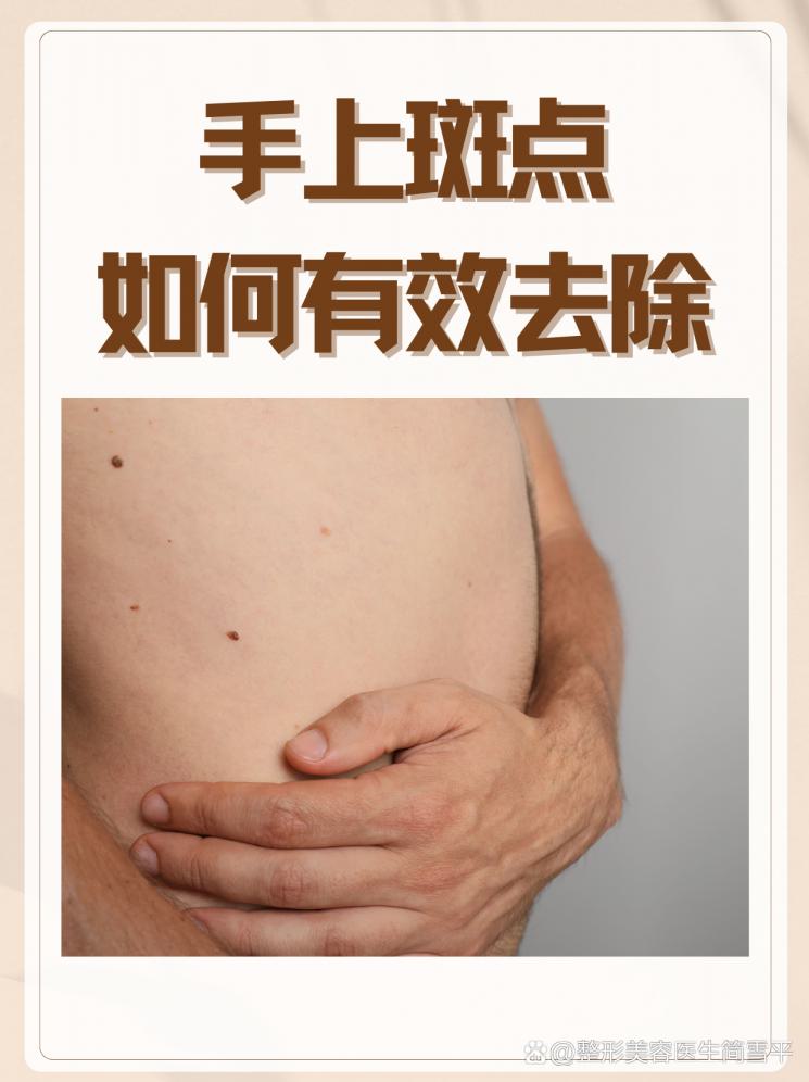 手上斑点如何有效去除