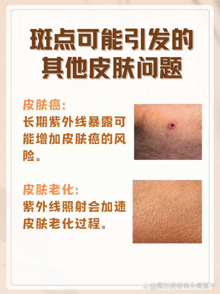 手上斑点如何有效去除
