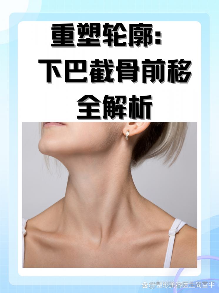 重塑轮廓：下巴截骨前移全解析