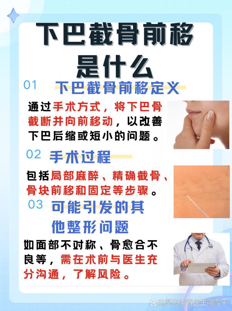 重塑轮廓：下巴截骨前移全解析