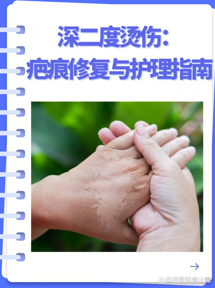深二度烫伤：疤痕修复与护理指南
