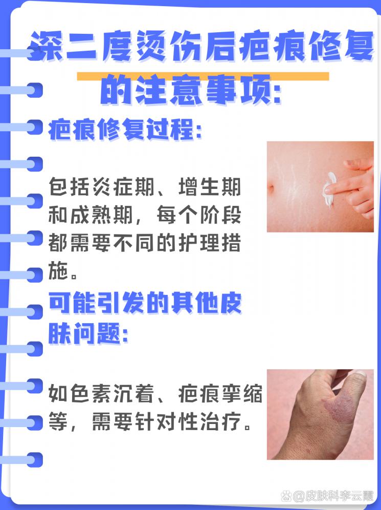 深二度烫伤：疤痕修复与护理指南