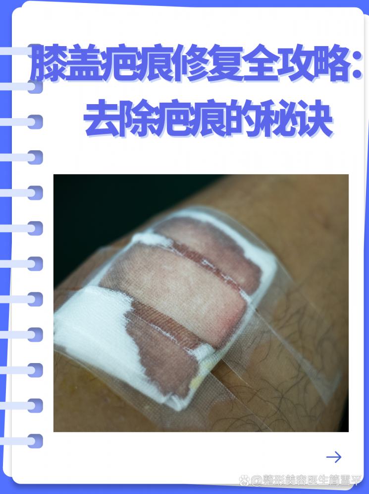 膝盖疤痕修复全攻略：去除疤痕的秘诀