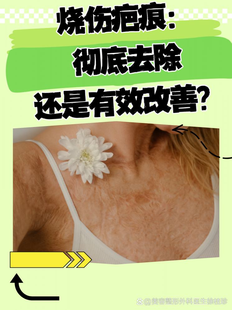 烧伤疤痕：彻底去除还是有效改善？