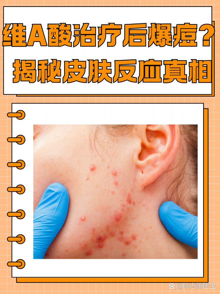 维A酸治疗后爆痘？揭秘皮肤反应真相