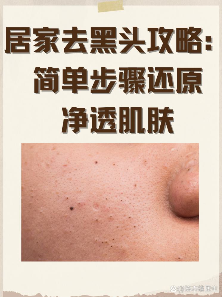 居家去黑头攻略：简单步骤还原净透肌肤