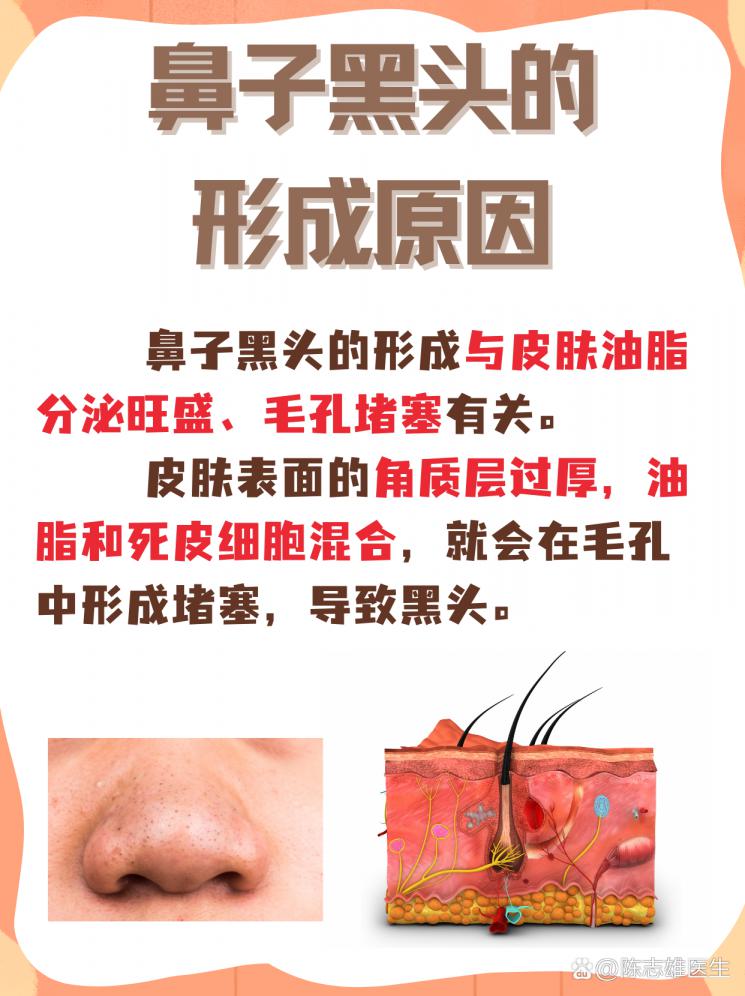 揭秘鼻子黑头：毛孔堵塞的真相