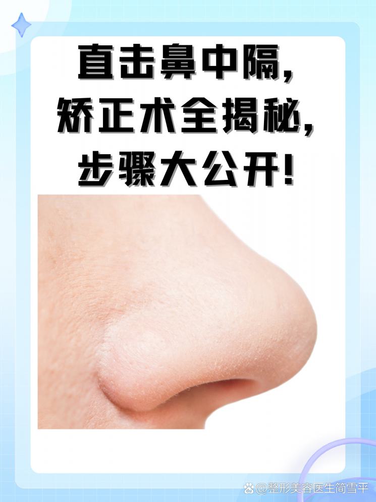 直击鼻中隔，矫正术全揭秘，步骤大公开！