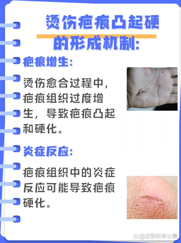 烫伤疤痕修复：硬凸起的解决之道