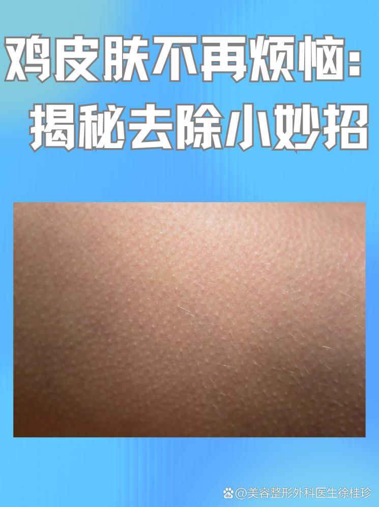 雞皮膚不再煩惱：揭秘去除小妙招