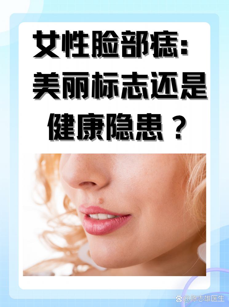 女性臉部痣：美麗標(biāo)志還是健康隱患？