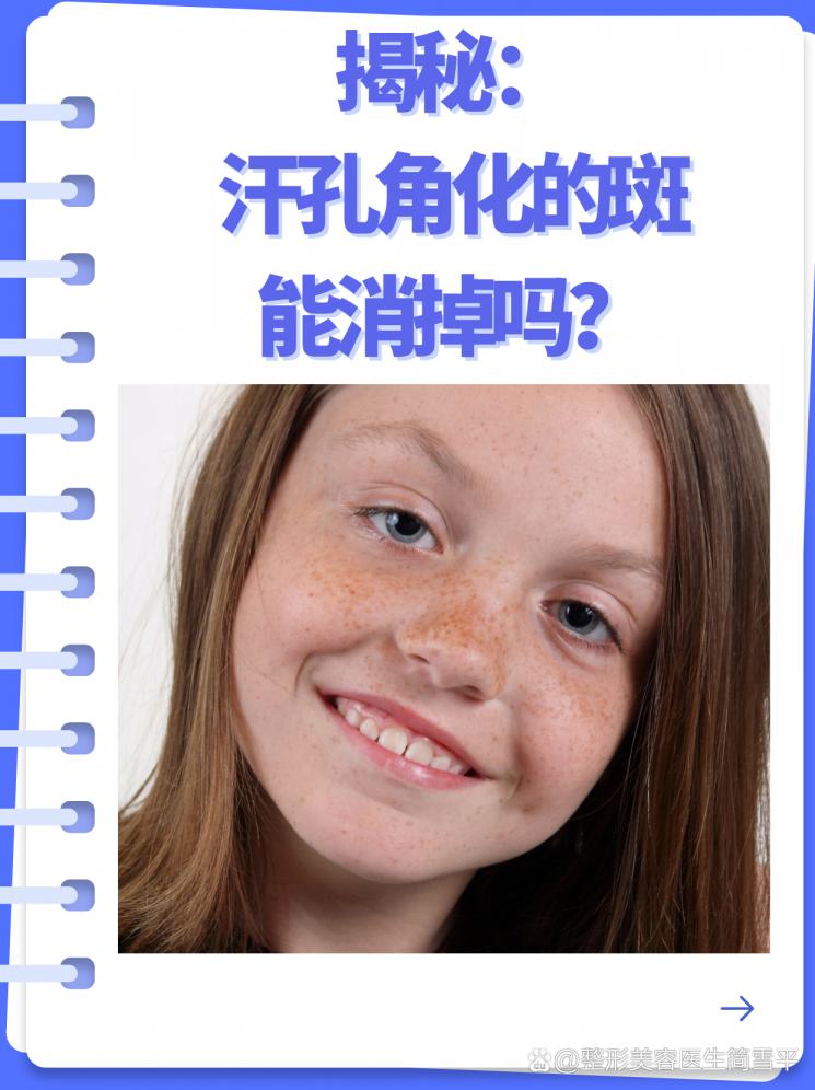 揭秘：汗孔角化的斑能消掉嗎？