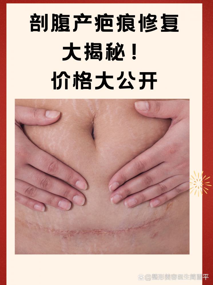 剖腹產(chǎn)疤痕修復(fù)大揭秘！價(jià)格大公開