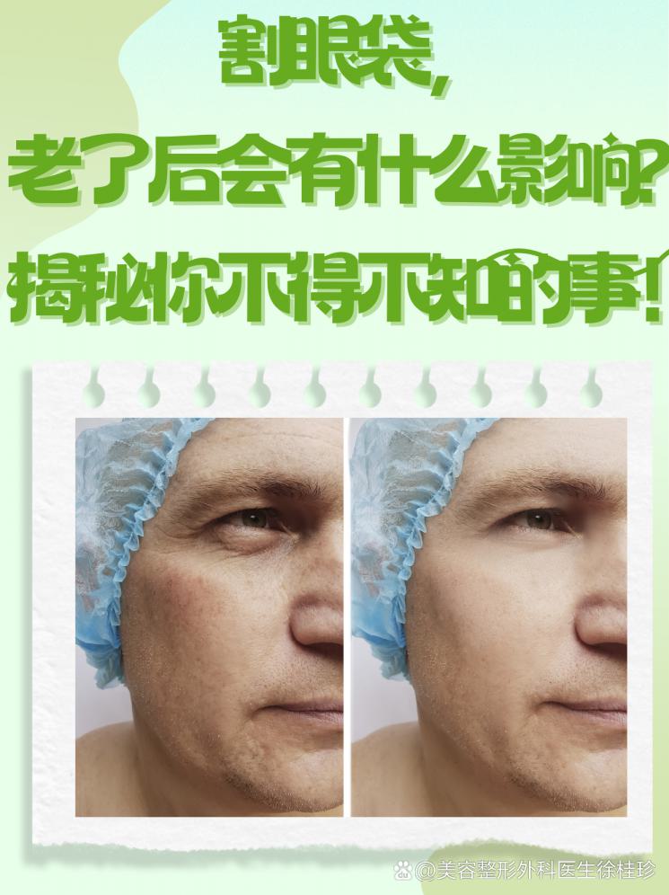 割眼袋，老了后會(huì)有什么影響？揭秘你不得不知的事！