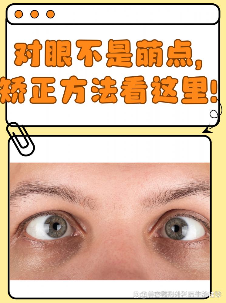 對眼不是萌點，矯正方法看這里！