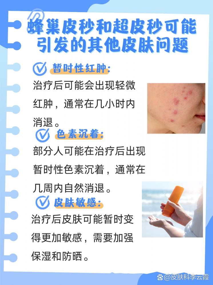 蜂巢PK超皮秒：揭秘兩者美膚差異