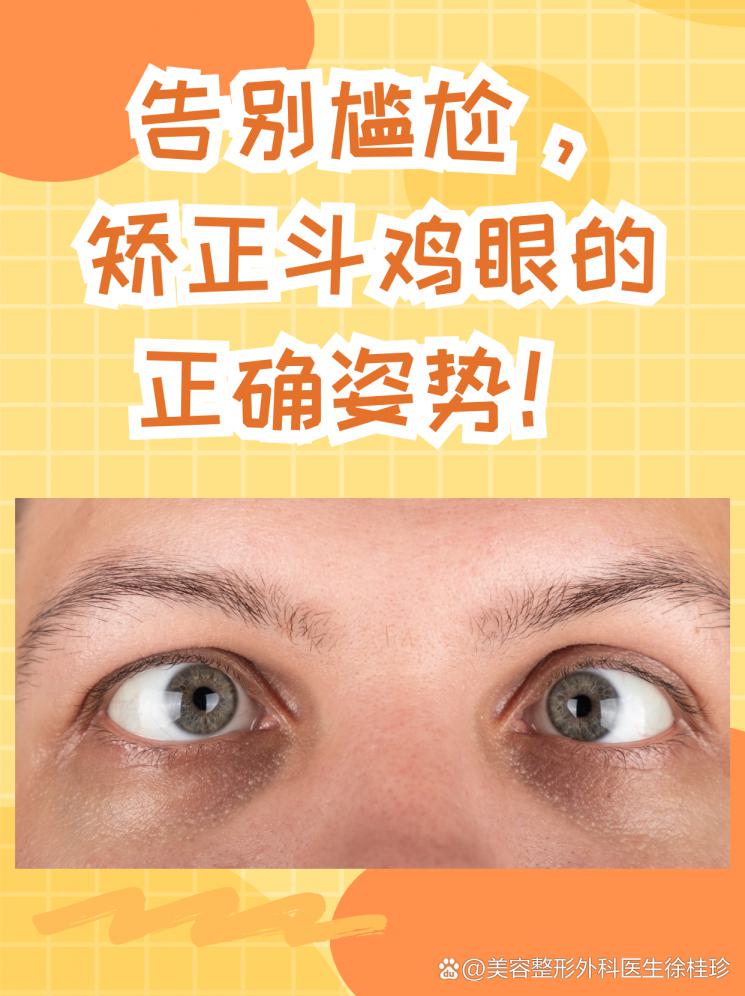 告別尷尬，矯正斗雞眼的正確姿勢！