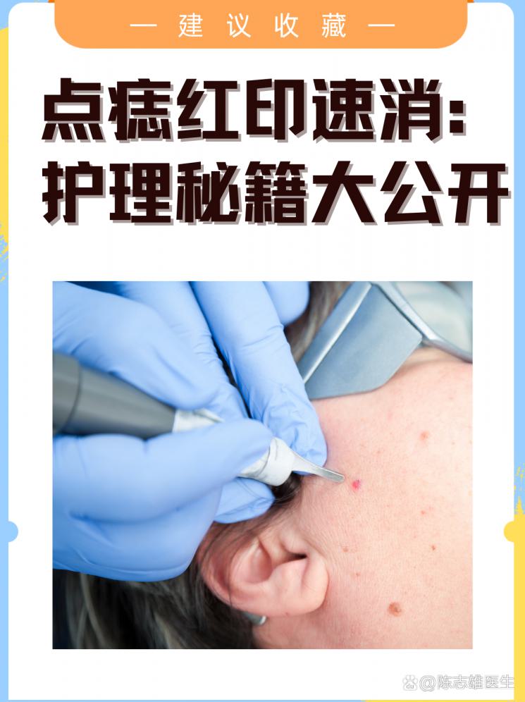 點痣紅印速消：護理秘籍大公開