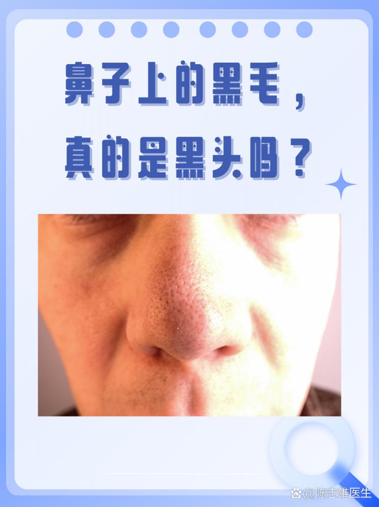 鼻子上的黑毛，真的是黑头吗？