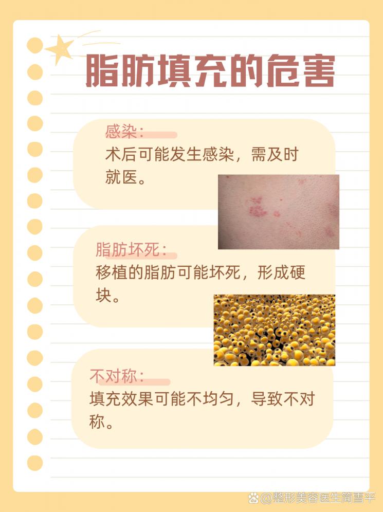 揭秘脂肪填充：美丽背后隐藏的风险