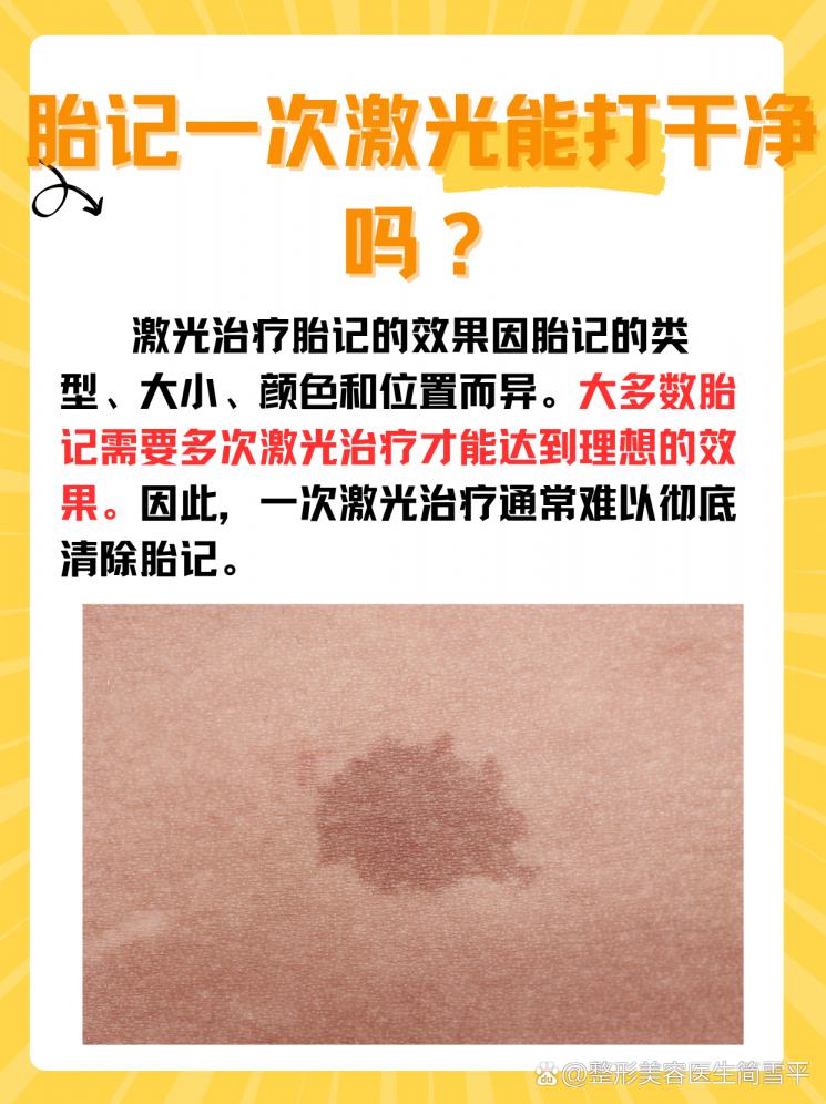 一次激光能否彻底清除胎记？深入揭秘真相！