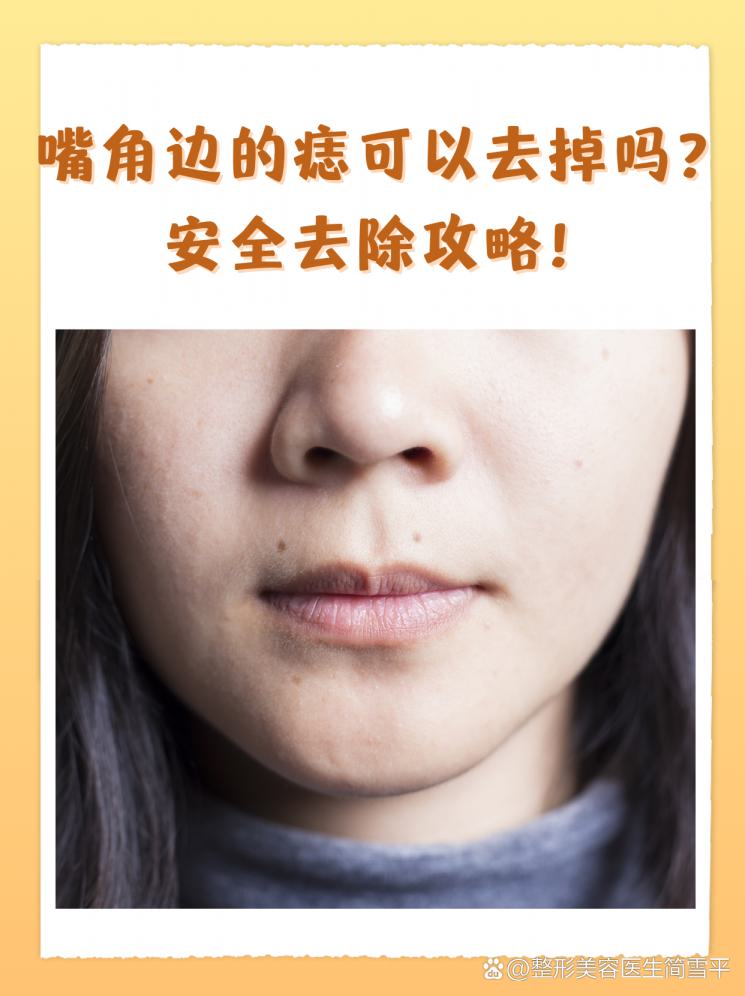 嘴角边的痣可以去掉吗？安全去除攻略！