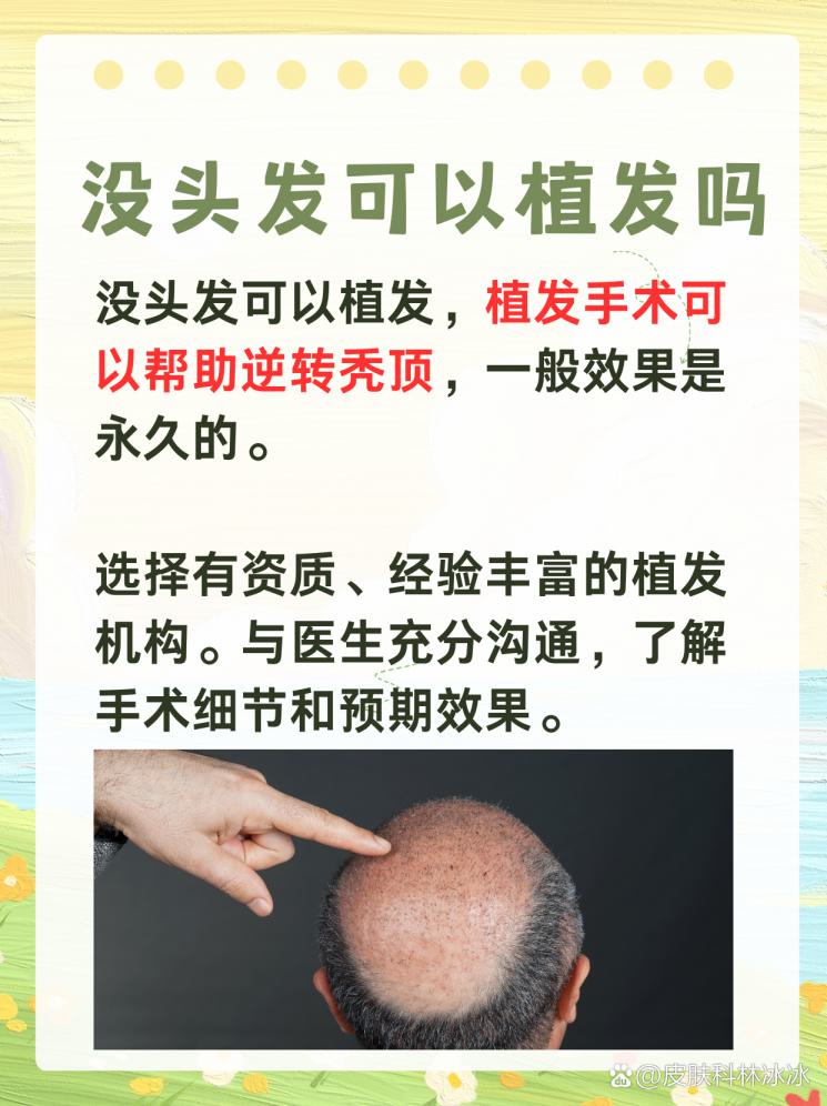 植发可能：秃顶逆转，秀发新生
