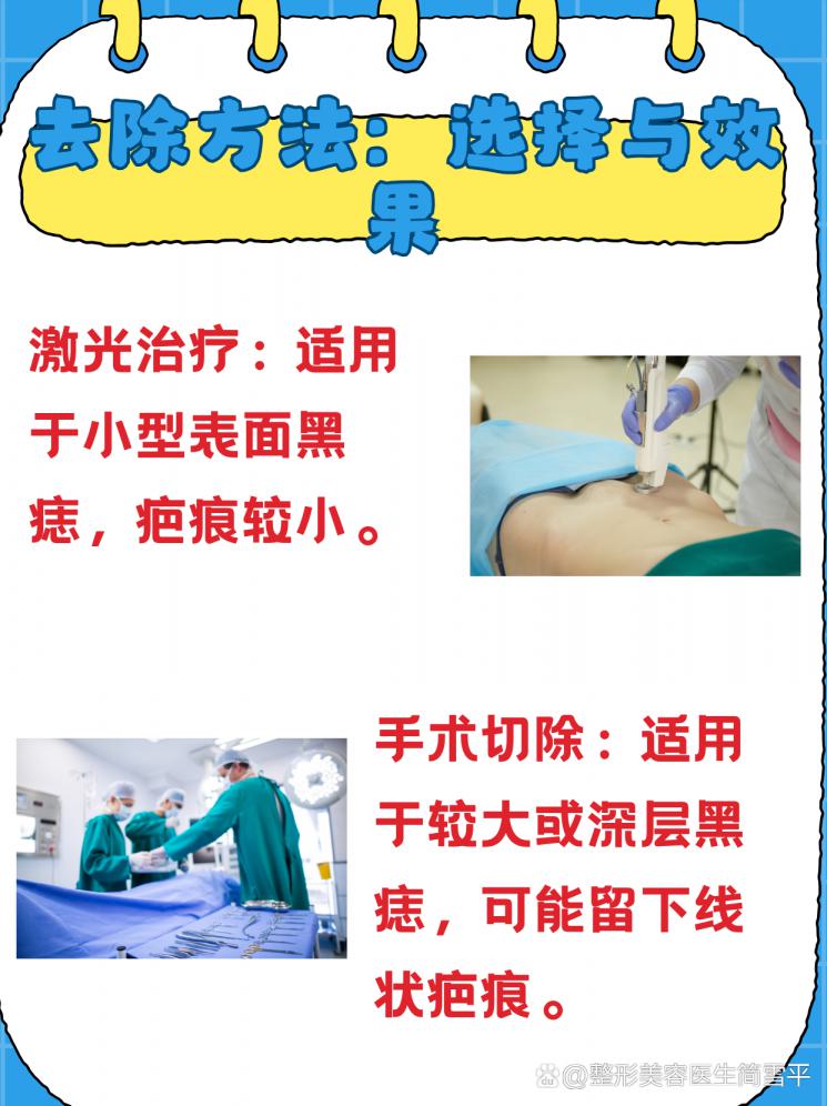 黑痣去除：美丽不留痕的秘诀