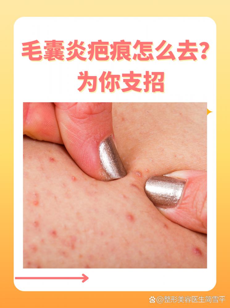 毛囊炎疤痕怎么去？为你支招