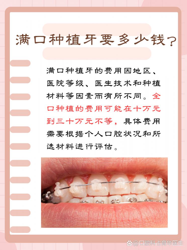 满口种植牙，费用大揭秘！