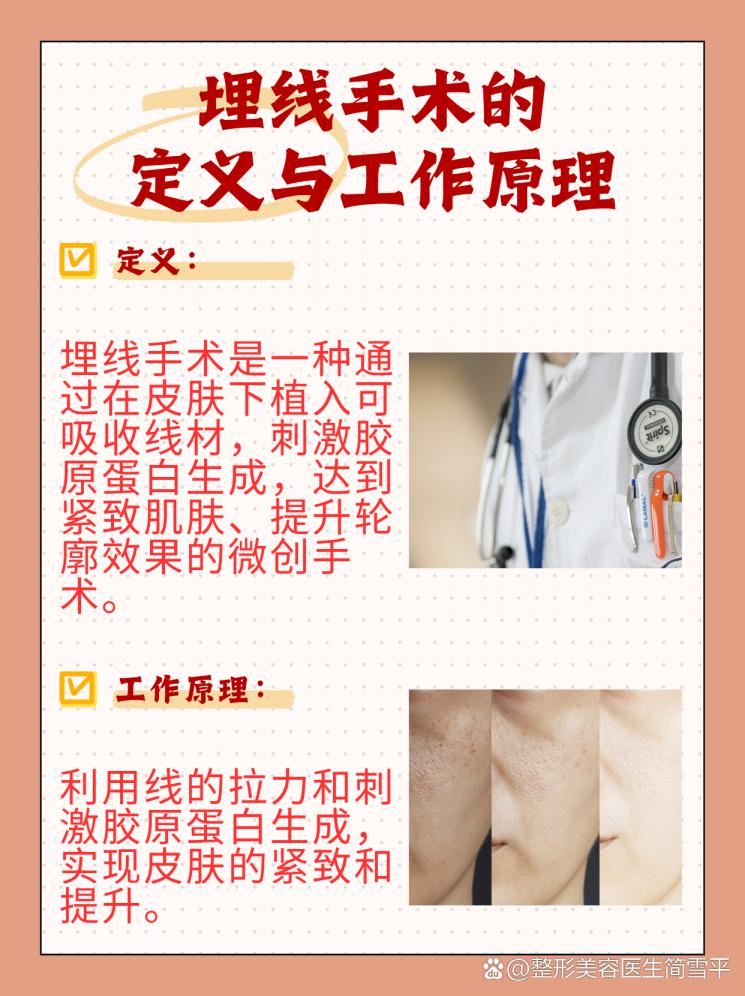 埋线手术全解析：你了解多少？