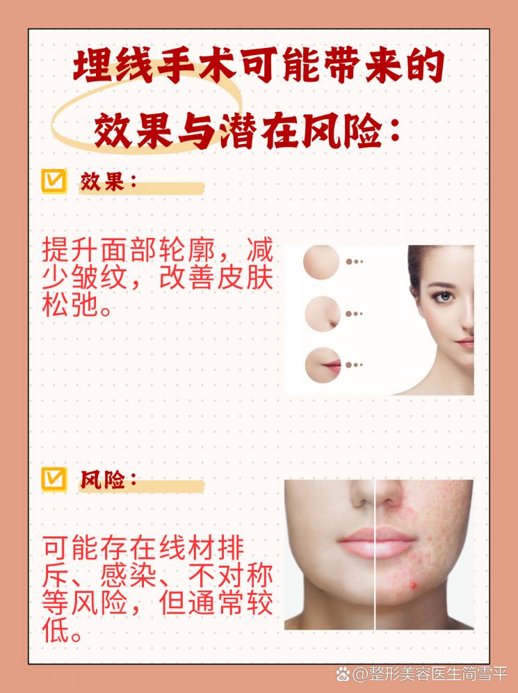 埋线手术全解析：你了解多少？