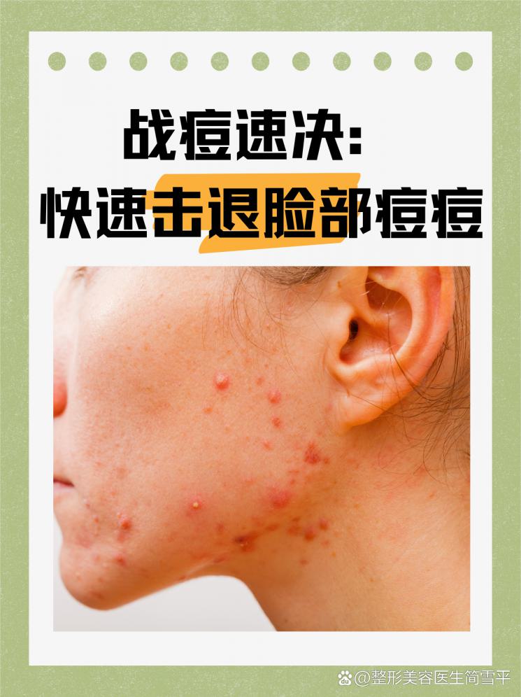 战痘速决：快速击退脸部痘痘
