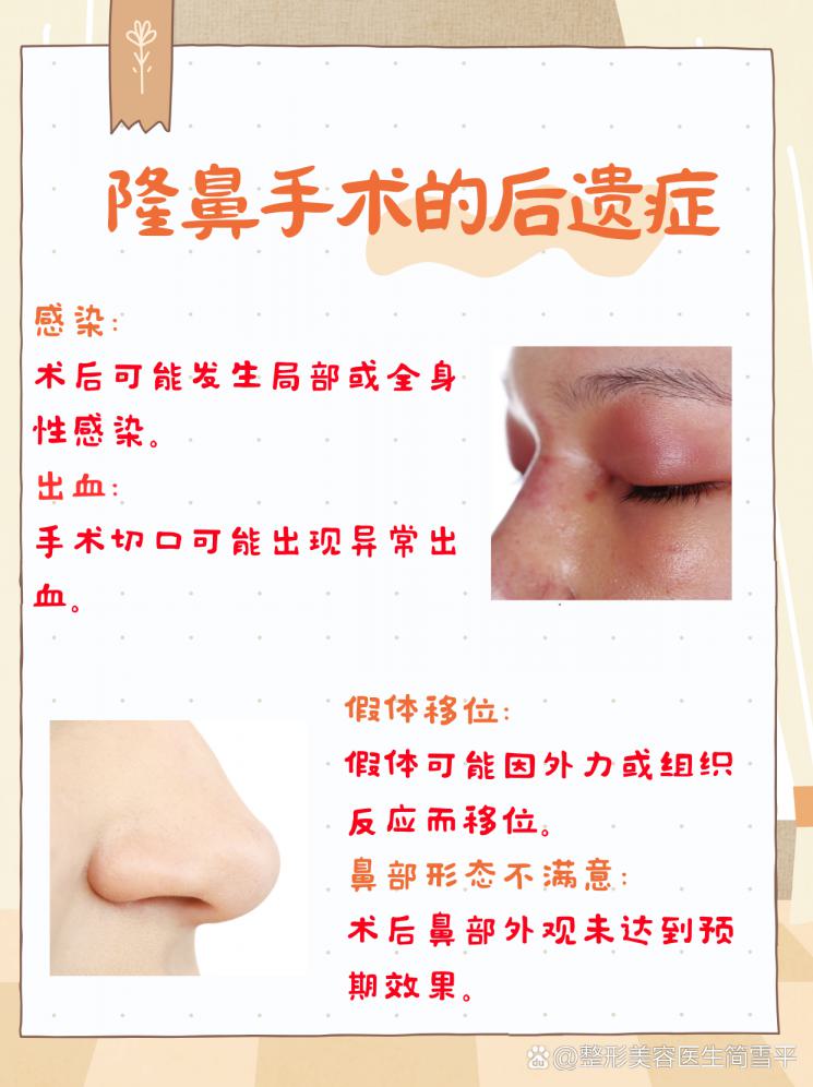 隆鼻后遗症全揭秘：美丽背后的风险