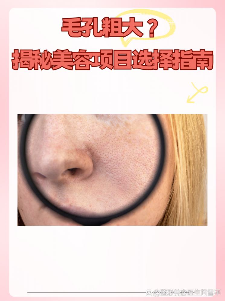 毛孔粗大？揭秘美容项目选择指南