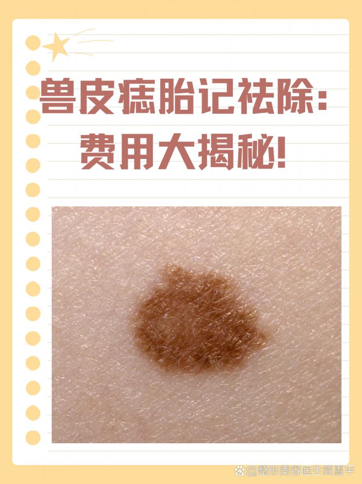 兽皮痣胎记祛除：费用大揭秘！