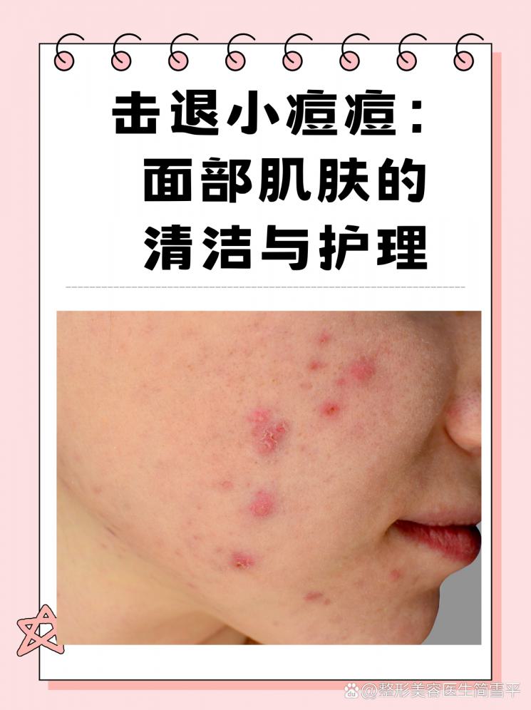 击退小痘痘：面部肌肤的清洁与护理