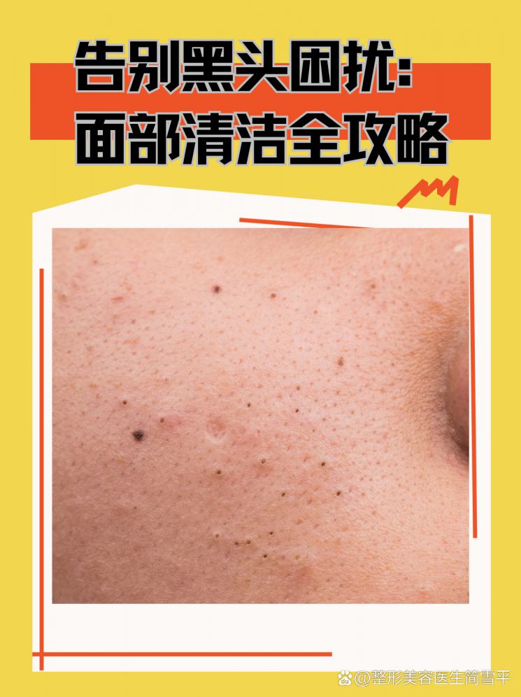 告别黑头困扰：面部清洁全攻略