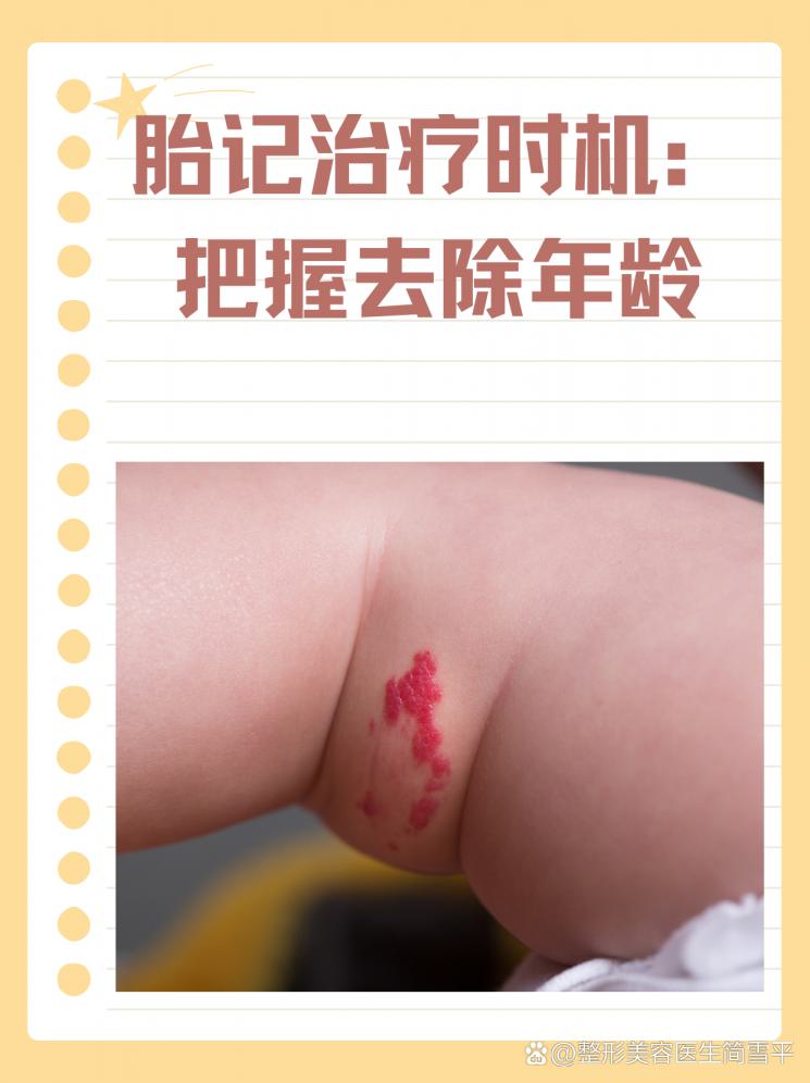 胎记治疗时机：把握去除年龄