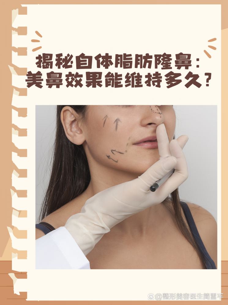 揭秘自体脂肪隆鼻：美鼻效果能维持多久？