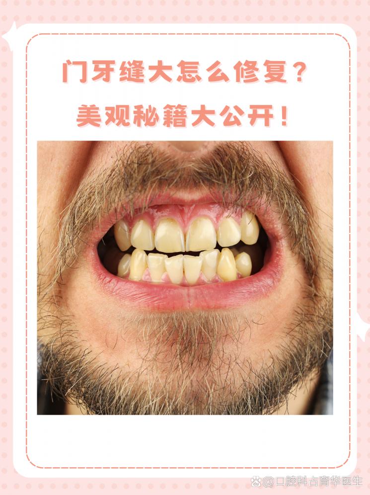 门牙缝大怎么修复？美观秘籍大公开！