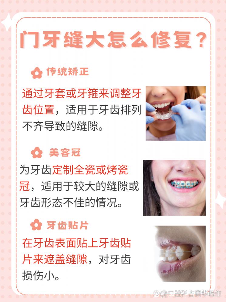 门牙缝大怎么修复？美观秘籍大公开！