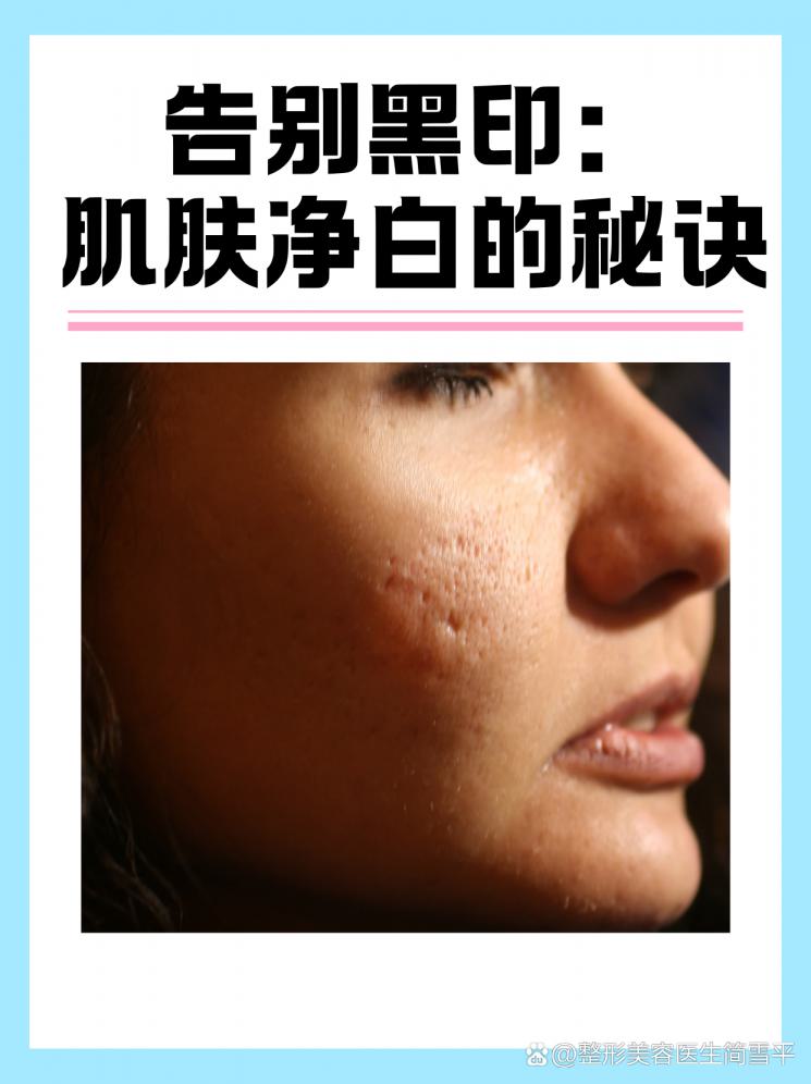 告别黑印：肌肤净白的秘诀