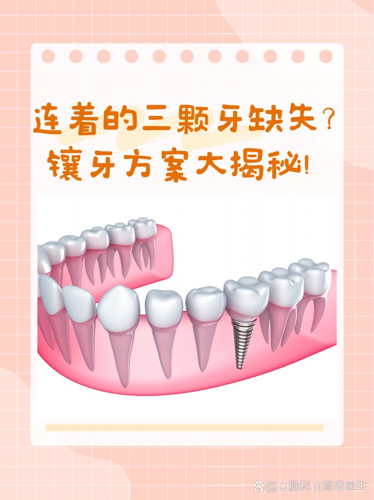 连着的三颗牙缺失？镶牙方案大揭秘！