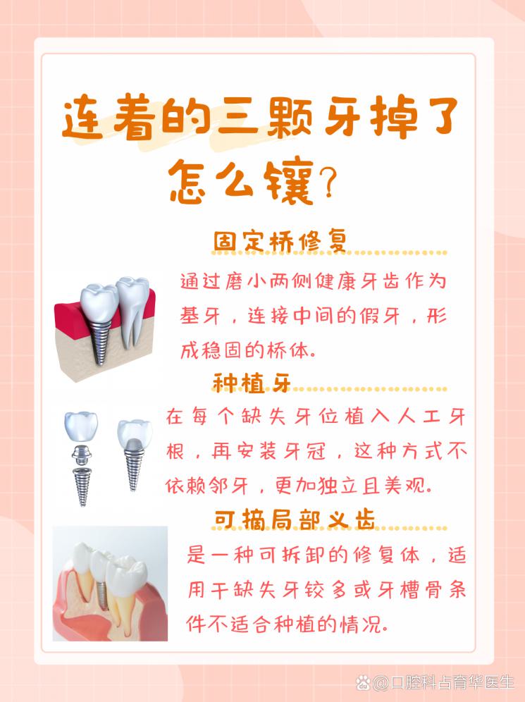 连着的三颗牙缺失？镶牙方案大揭秘！
