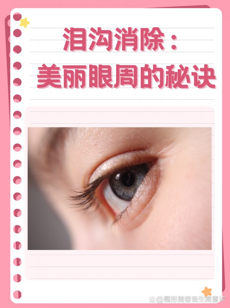 泪沟消除：美丽眼周的秘诀